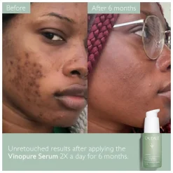 Caudalie Vinopure Blemish Control Salicylic Serum