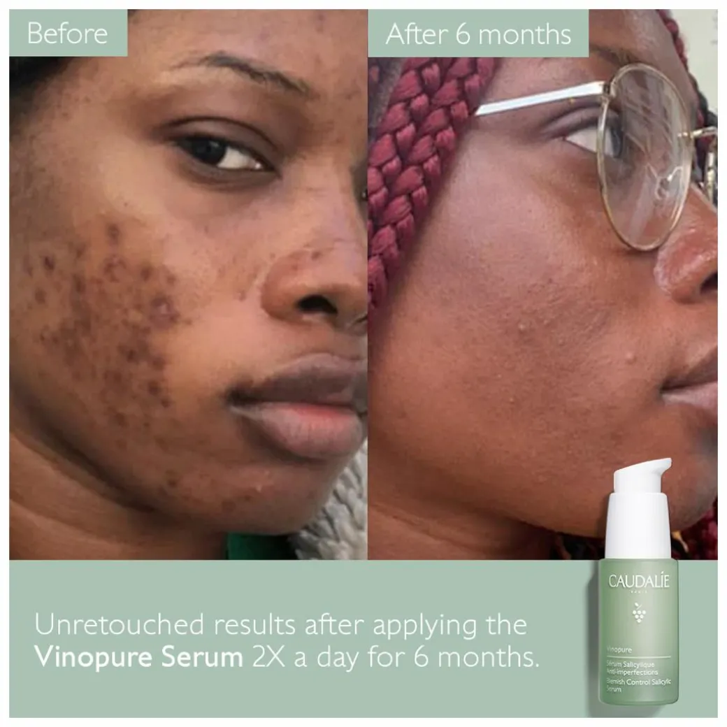 Caudalie Vinopure Blemish Control Salicylic Serum